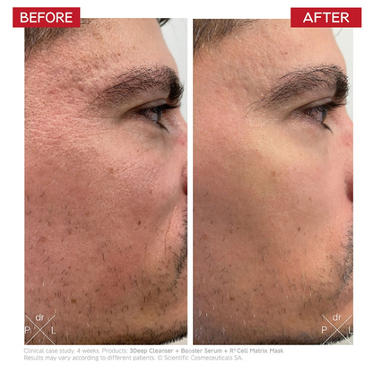 Before and after comparison of a man's face with skin treatment results.