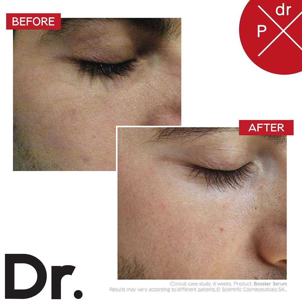 Before and after comparison of skin treatment on a person's eye area with 'Dr.' branding.