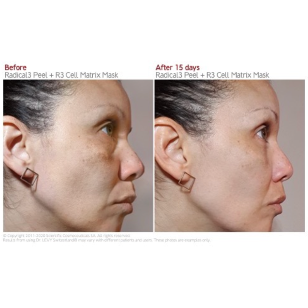 Dr. Levy Radical3 Reboot Peel