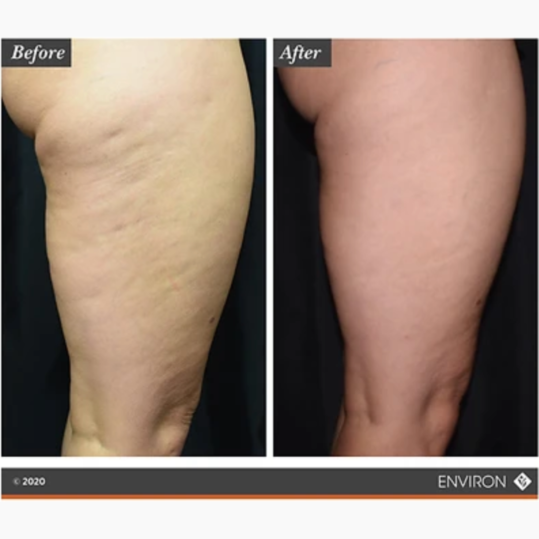 Supercharge Skin Health: See You Later, Cellulite