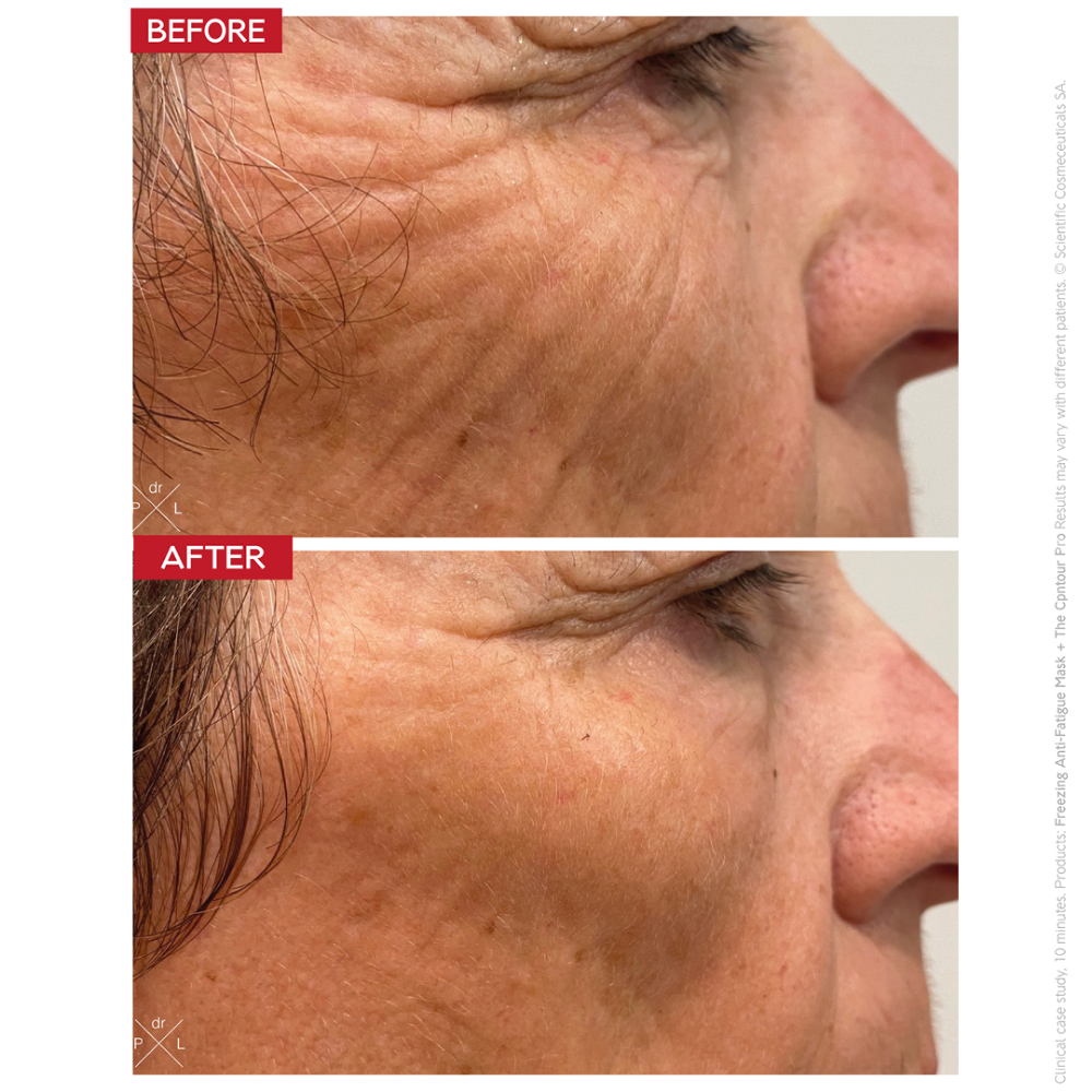 Dr. Levy Contour Pro | At-Home EMS + RF Facial Sculpting Device