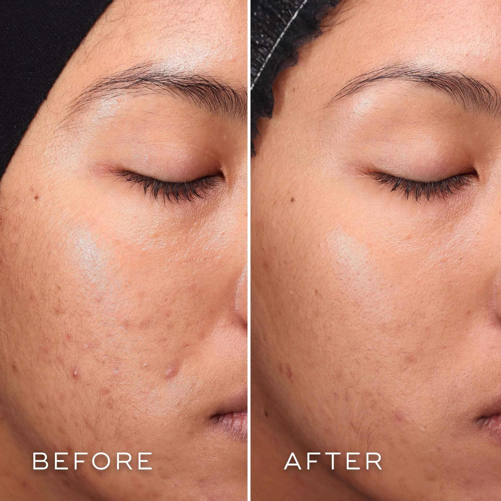 medik8 press & clear before and after image